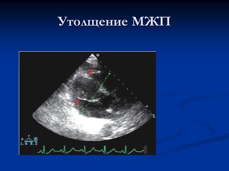 Утолщение МЖП